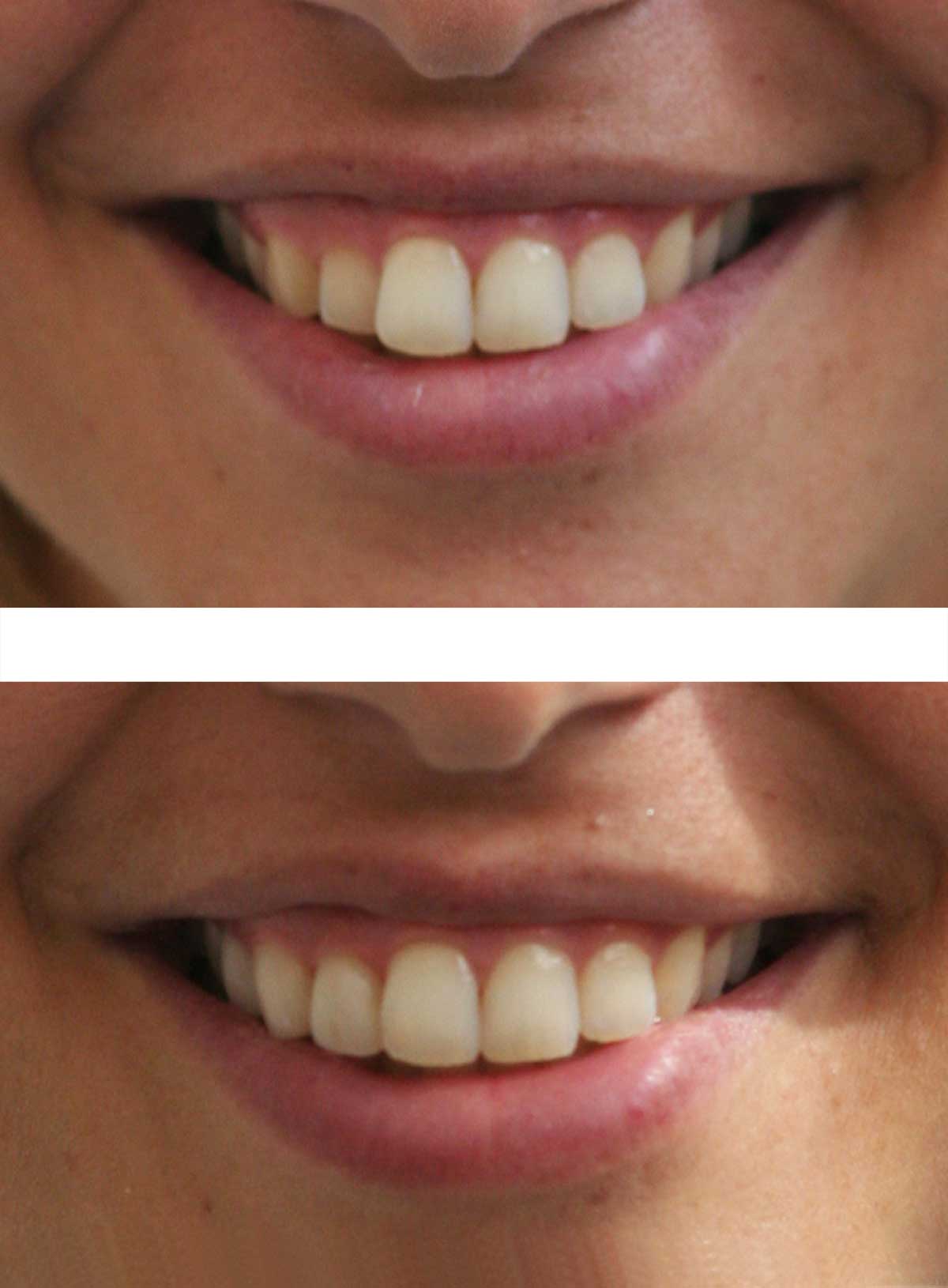 Caso 2 Estetica dentale donna