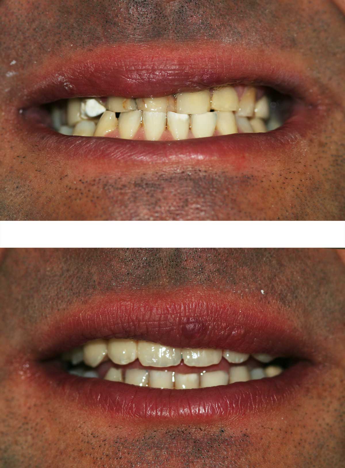 Caso 4 Estetica dentale donna