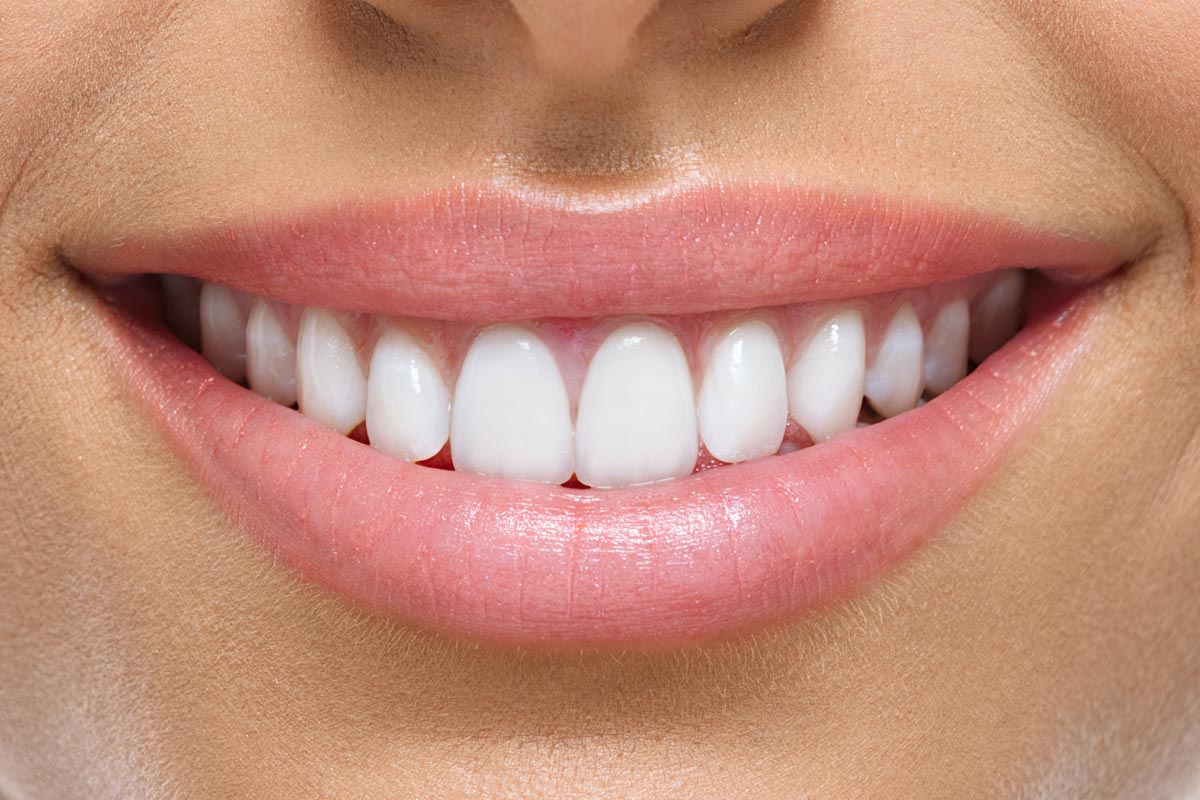 Sbiancamento dentale donna