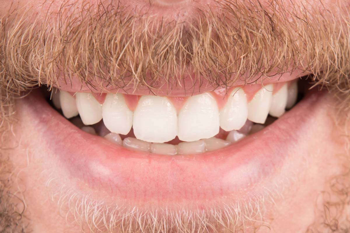 Estetica dentale uomo